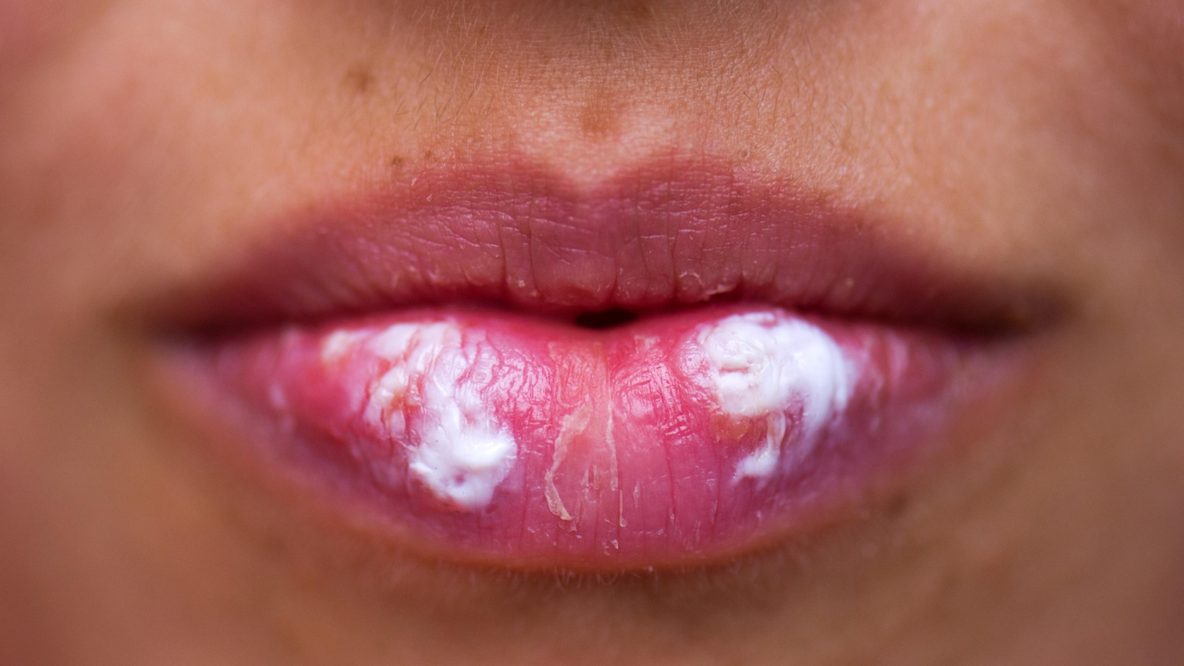 Fieberbläschen auf den Lippen im Anfangsstadium