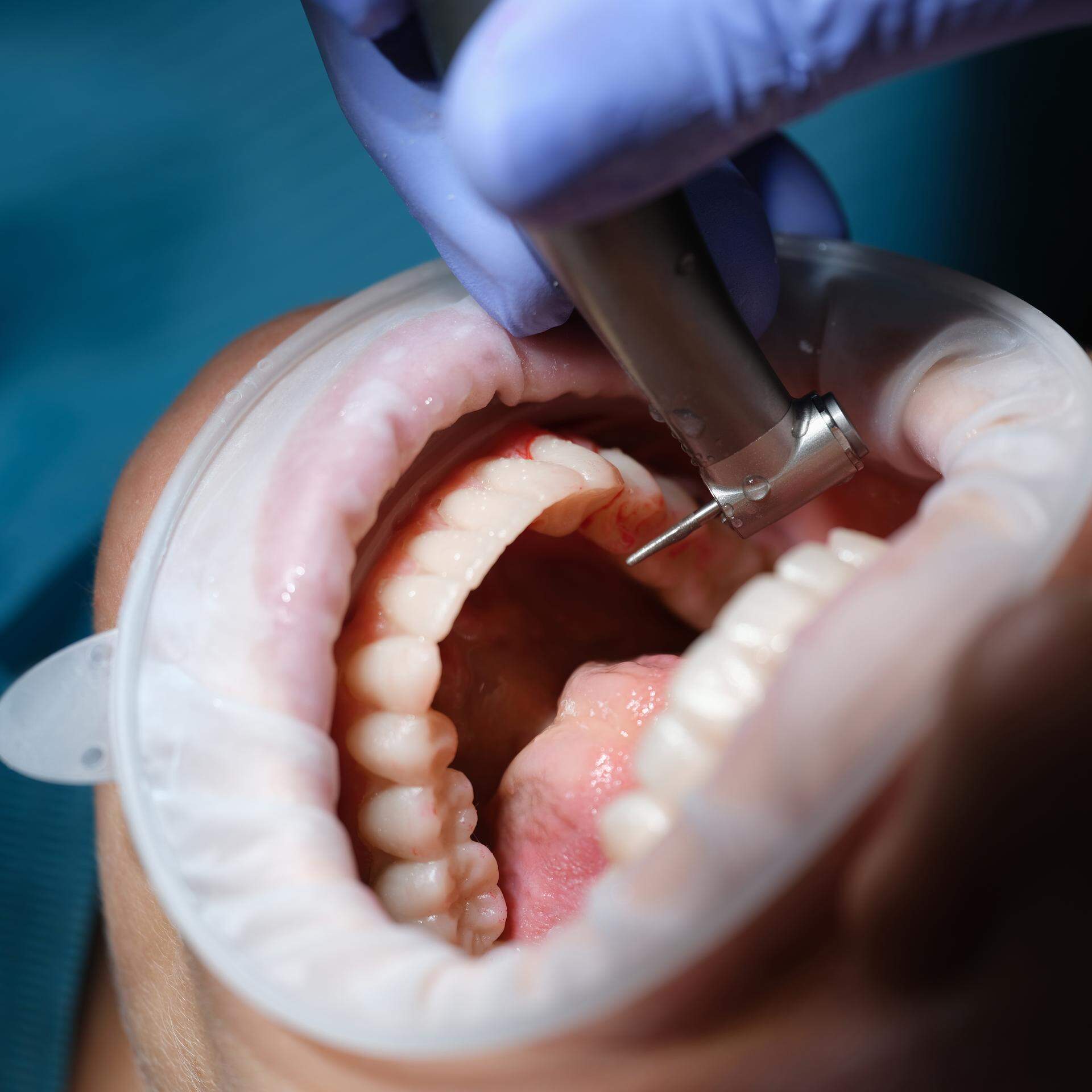 Einem Zahnarzt werden Behandlungsfehler und mangelnde Hygiene vorgeworfen.