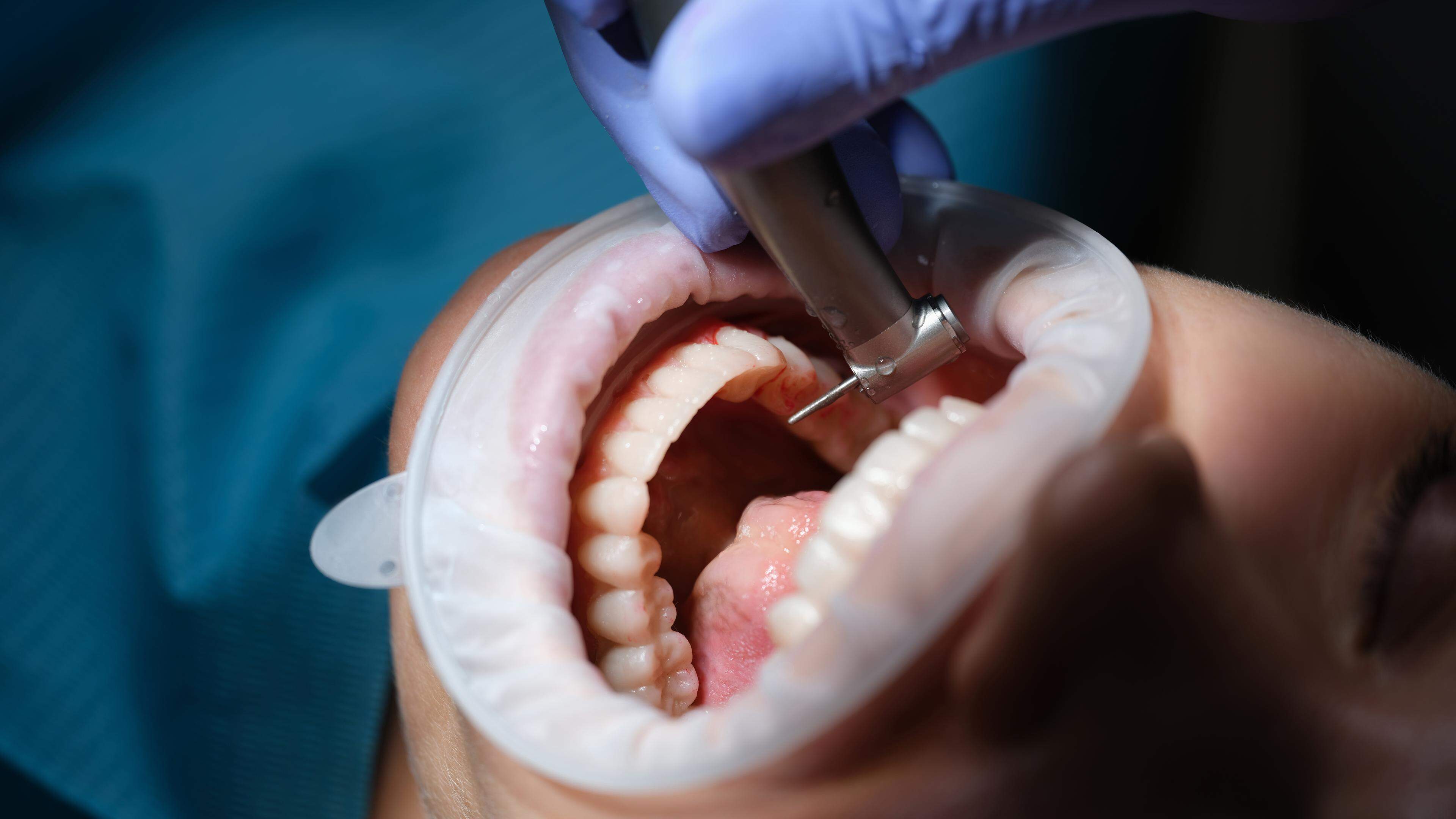 Einem Zahnarzt werden Behandlungsfehler und mangelnde Hygiene vorgeworfen.