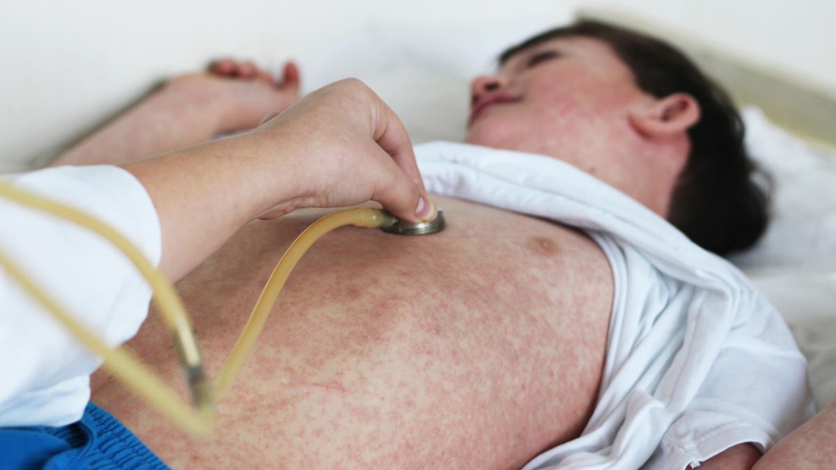 Hochansteckend-und-vermeidbar-Warum-Masernimpfungen-unverzichtbar-sind