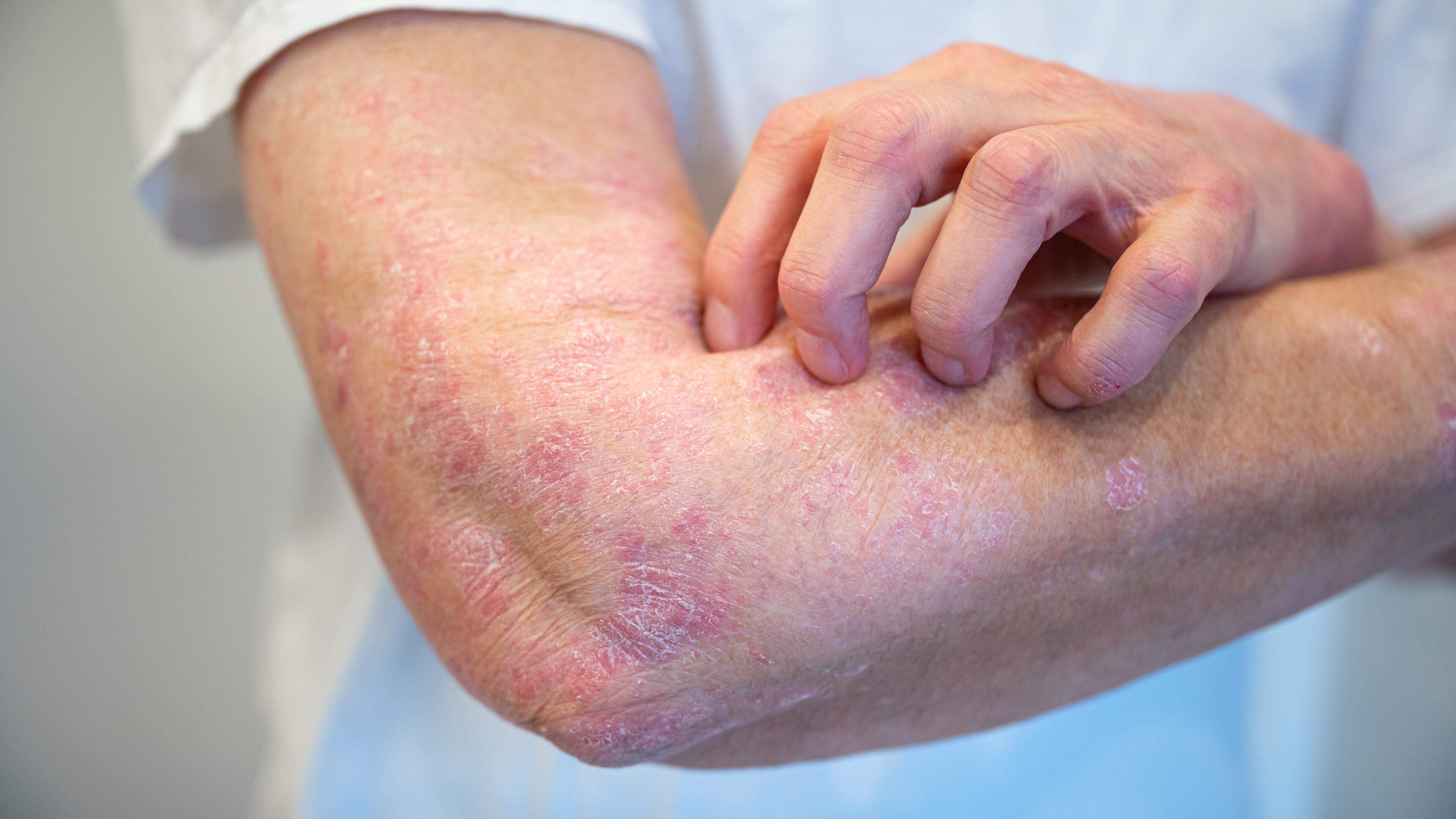 From nutrition to room air: which trigger can trigger a neurodermatitis boost