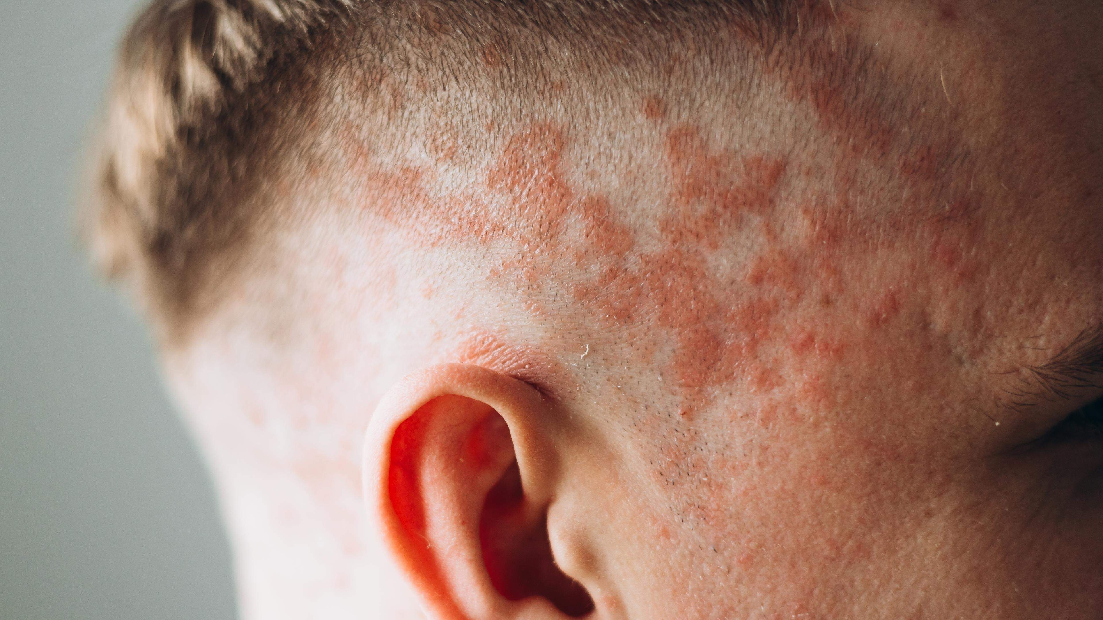 Skin, nails, joints – how psoriasis attacks the entire body