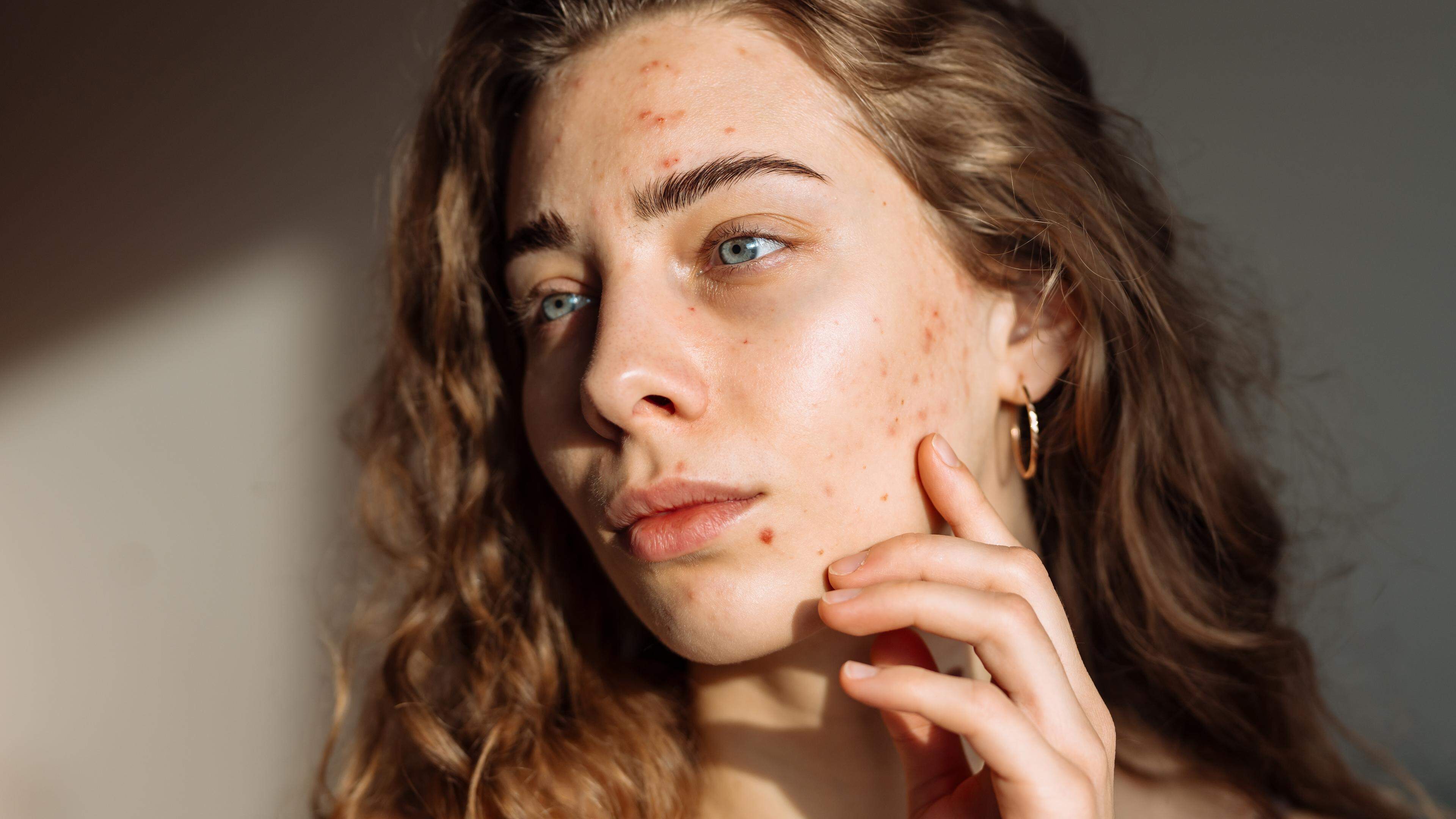 Pickel myths exposes: what really helps with acne
