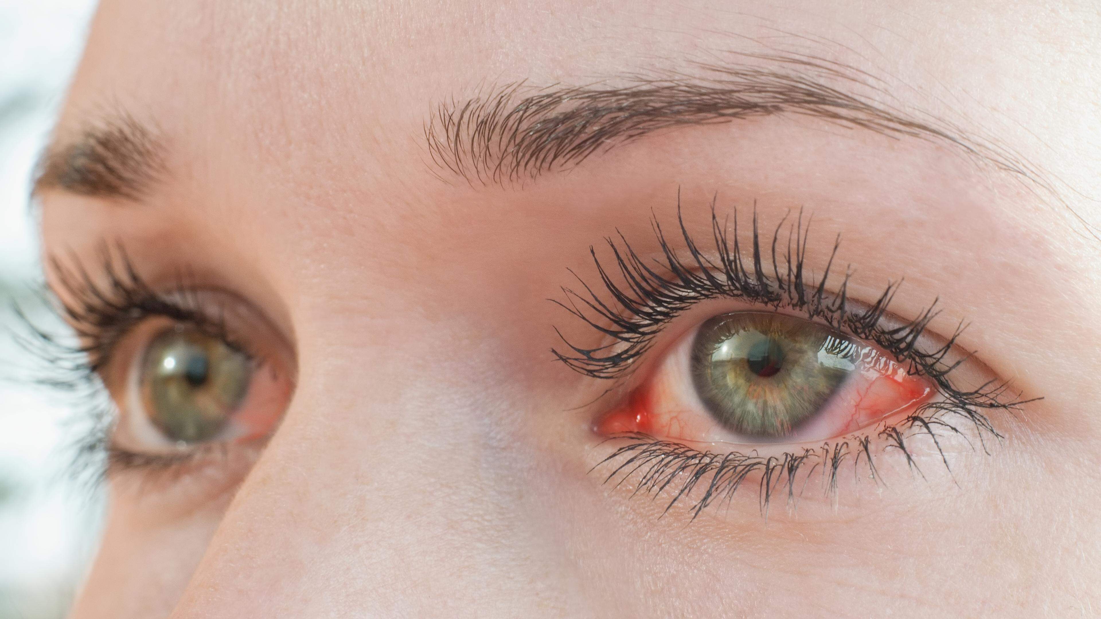 Conjunction: what is behind the eye disease